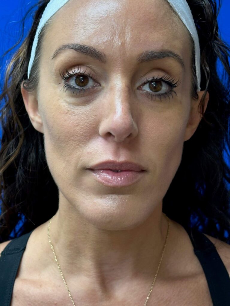 Before Image: Sculptra® - front