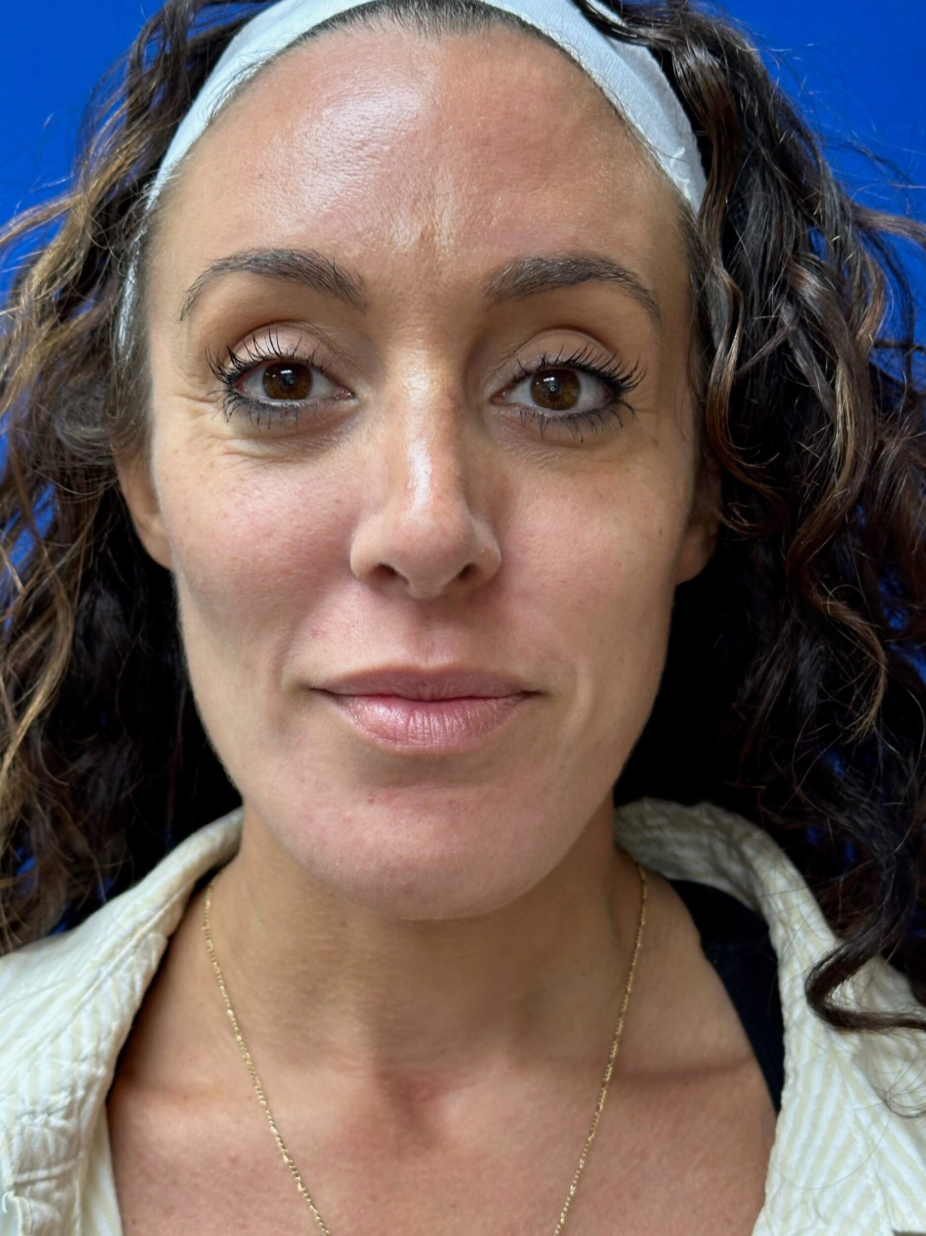 After Image: Dermal Fillers - front