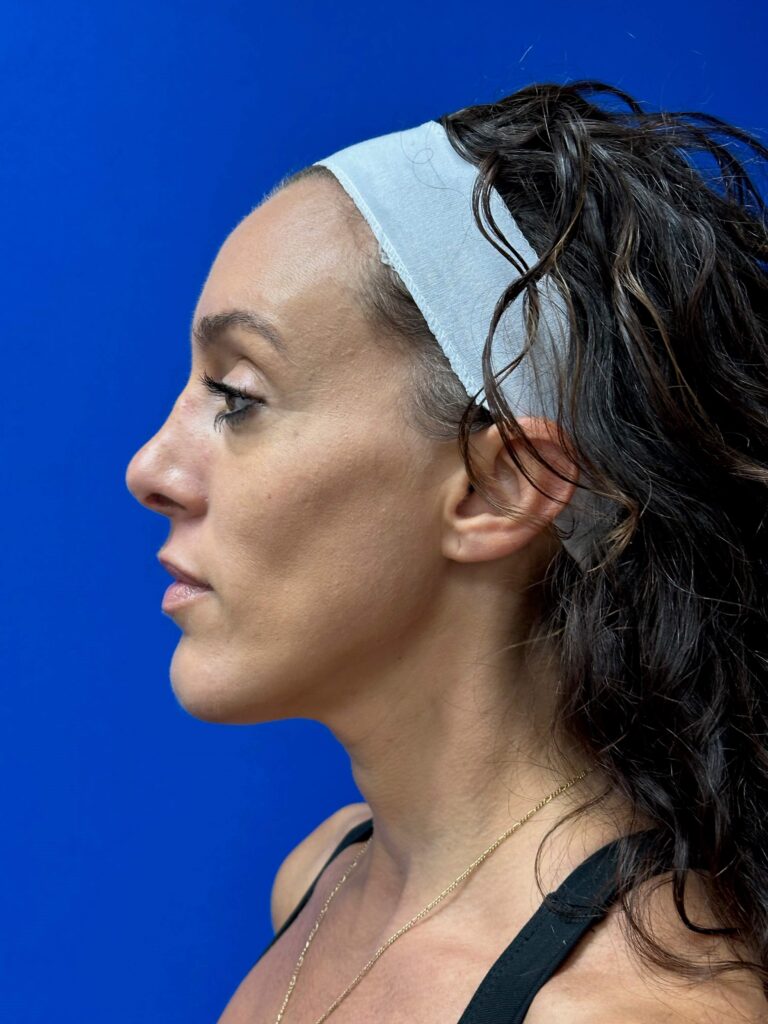 Before Image: Dermal Fillers - left-side