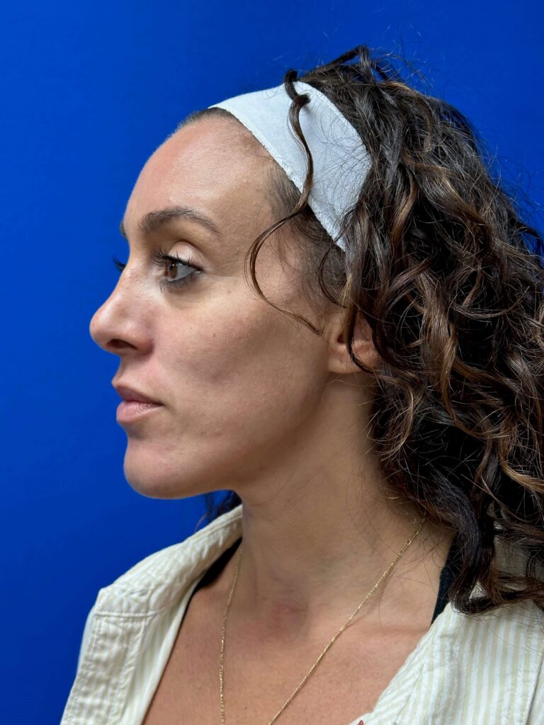 After Image: Dermal Fillers - left-side