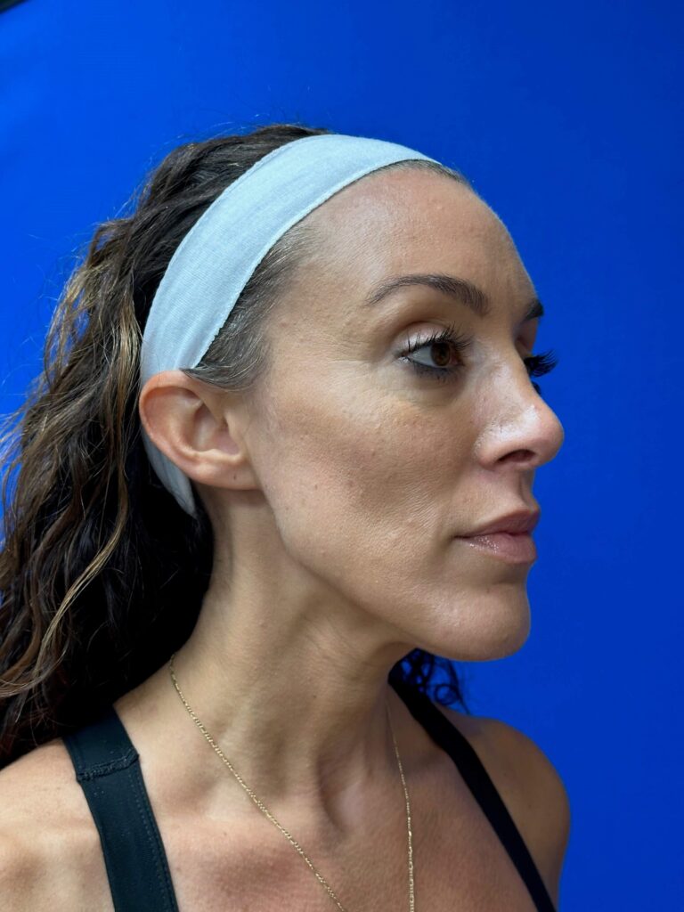 Before Image: Dermal Fillers - right-front-oblique