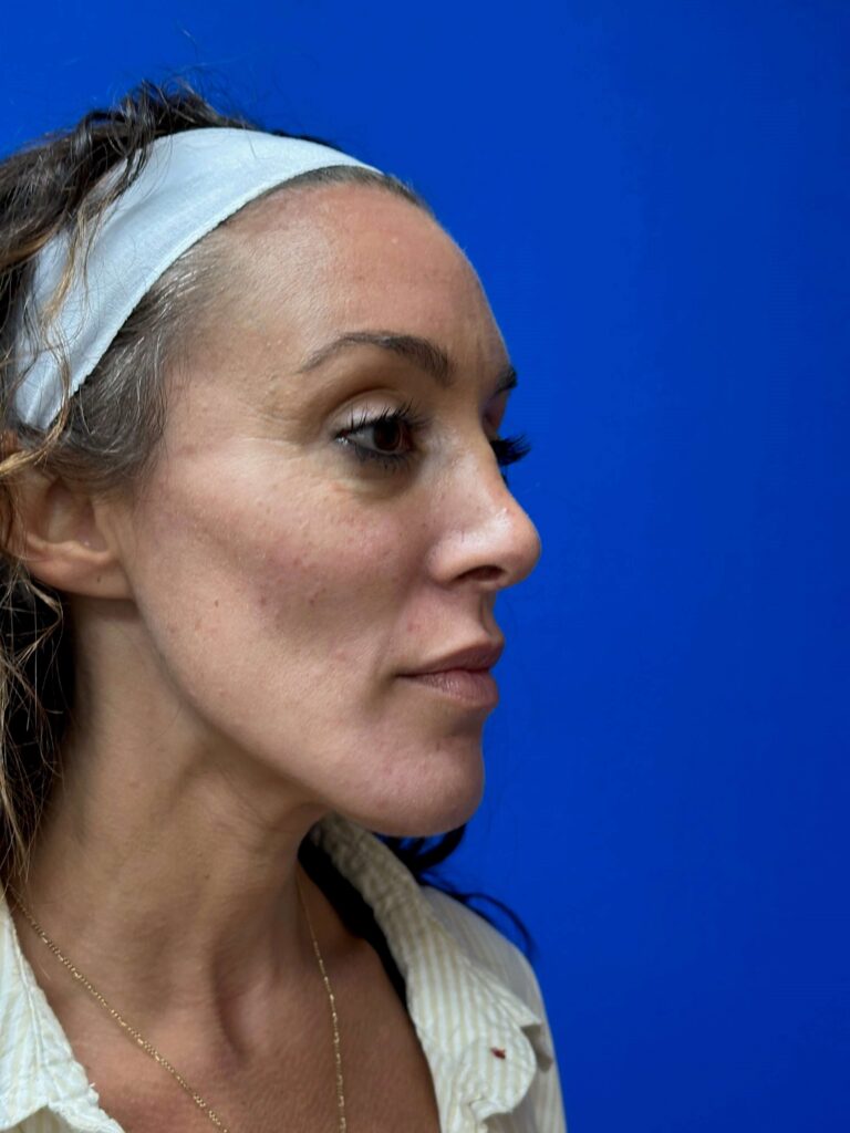 After Image: Sculptra® - right-front-oblique