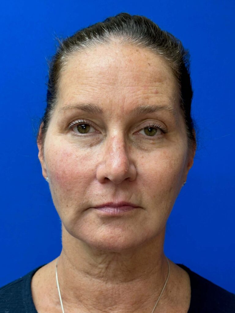 Before Image: Restylane® - front