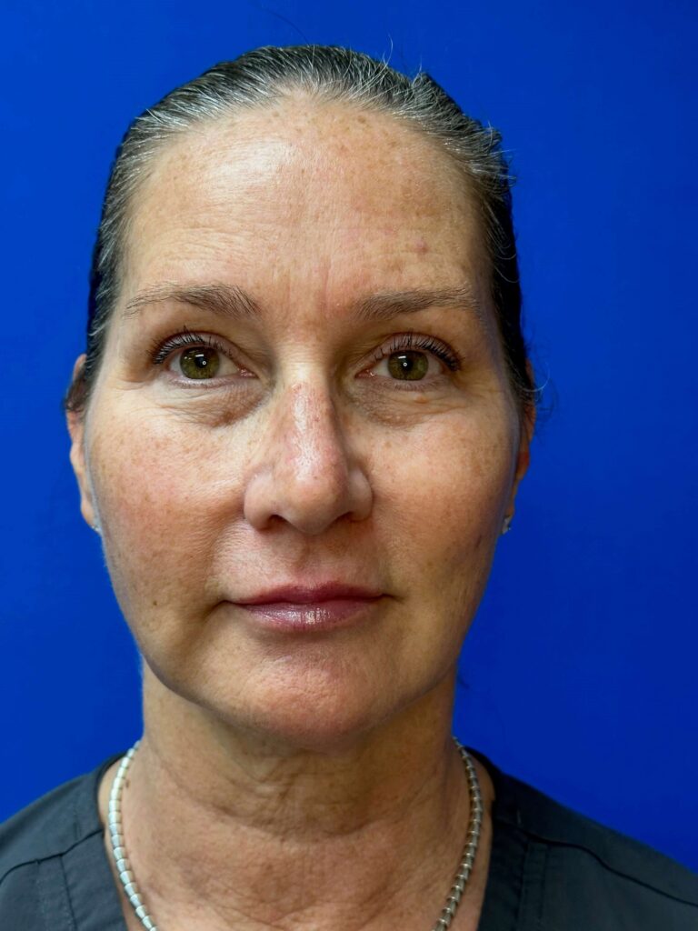 After Image: Restylane® - front