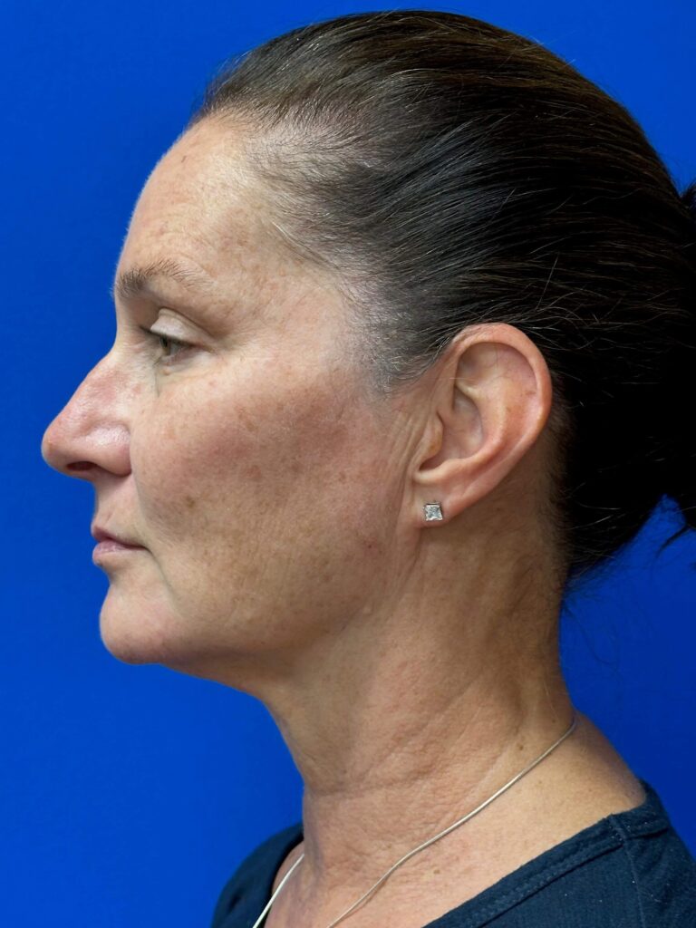 Before Image: Restylane® - left-side