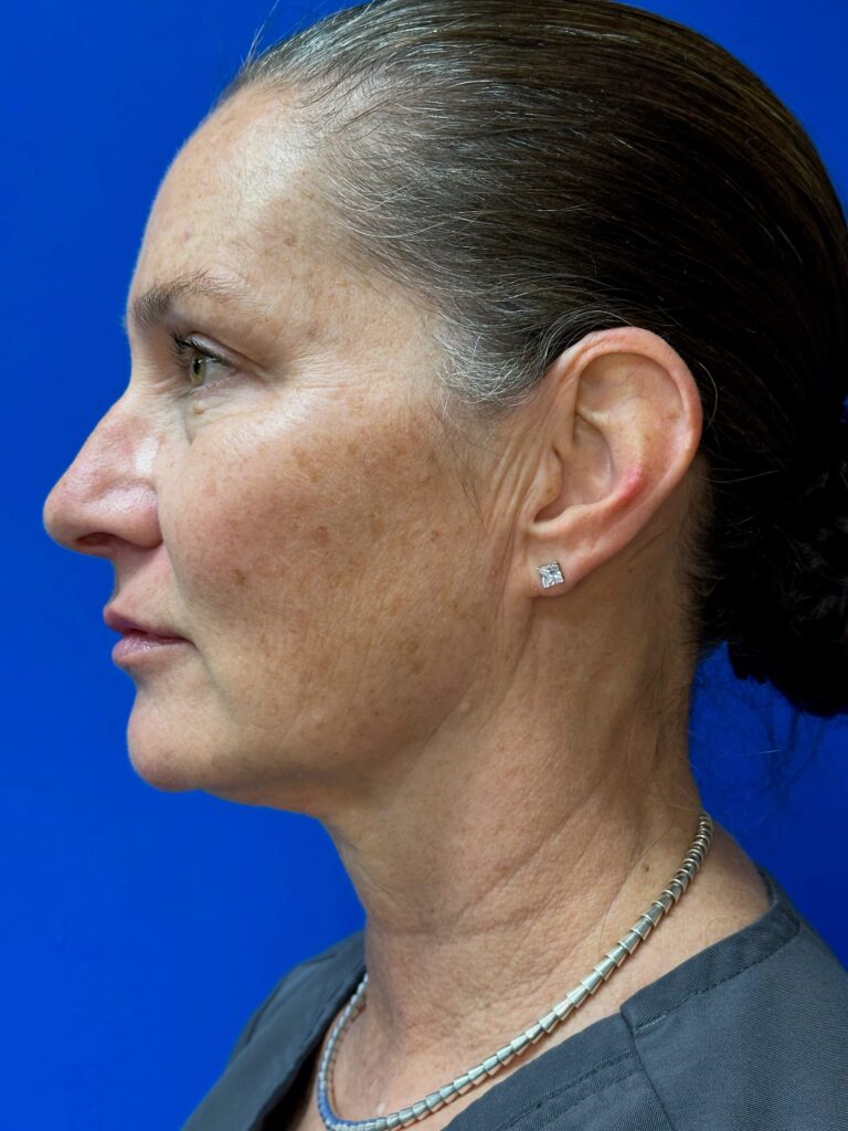 After Image: Restylane® - left-side