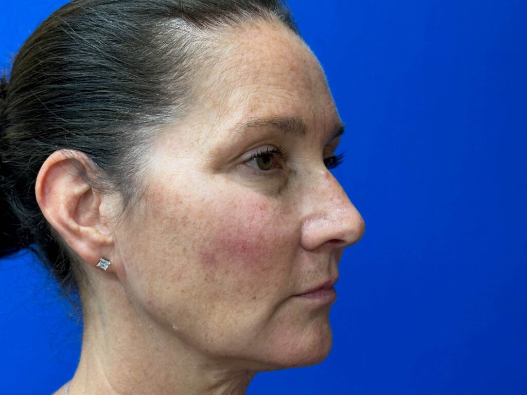 Before Image: Sculptra® - right-front-oblique