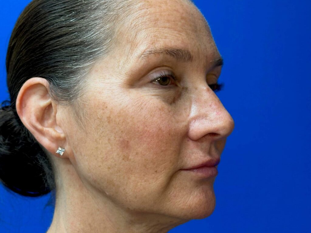 After Image: Sculptra® - right-front-oblique