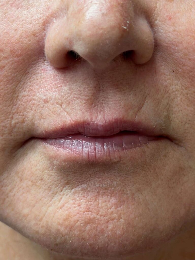 Before Image: Restylane® - front