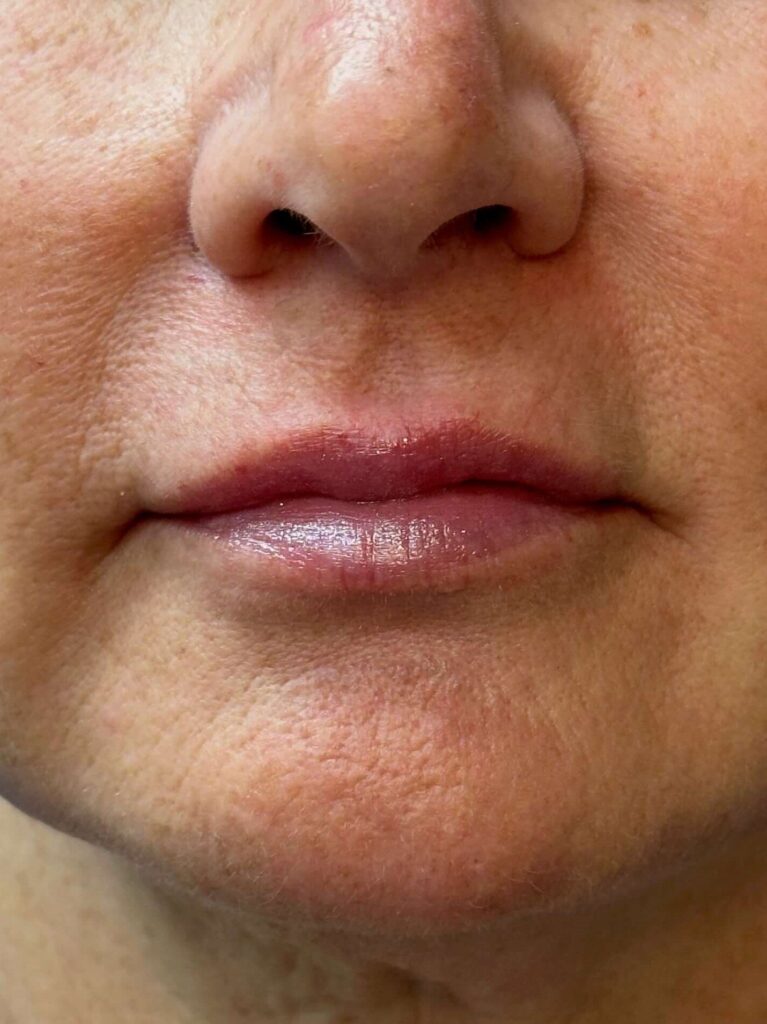 After Image: Restylane® - front