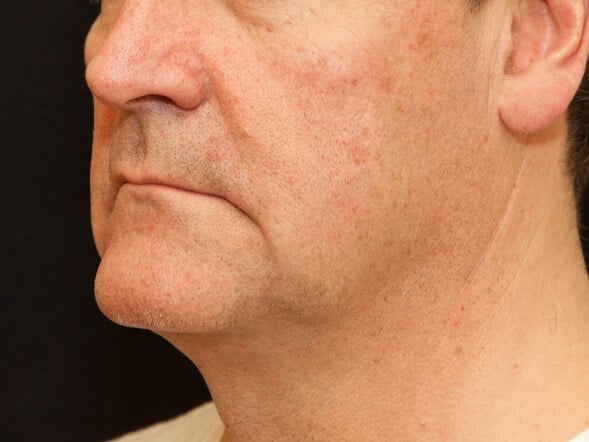 Before Image: ThermiTight® - left-front-oblique