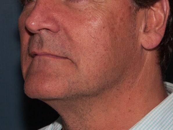 After Image: ThermiTight® - left-front-oblique