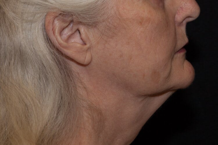 Before Image: ThermiTight® - right-side