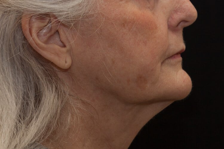 After Image: ThermiTight® - right-side