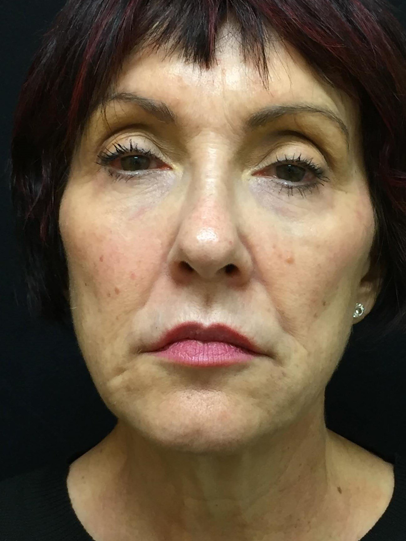 Before Image: Bellafill® - front