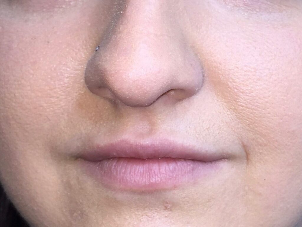 After Image: Restylane® - front
