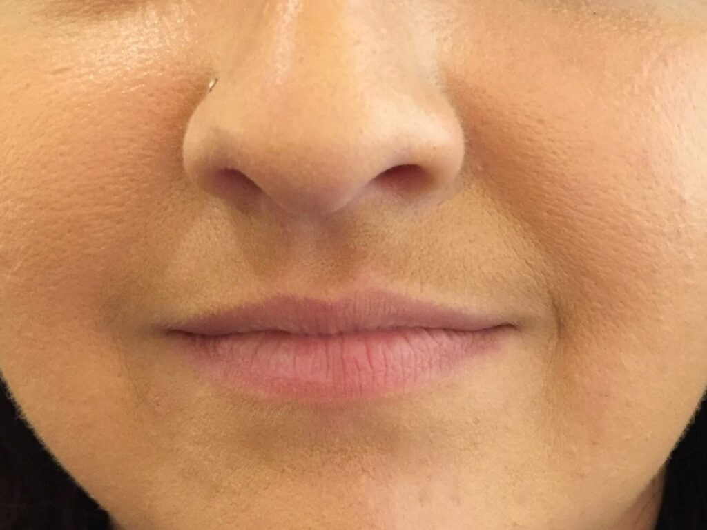 Before Image: Restylane® - front
