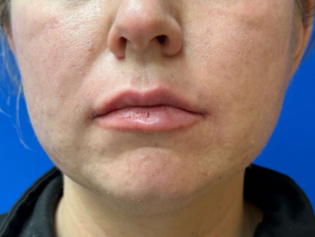 After Image: Restylane® - front