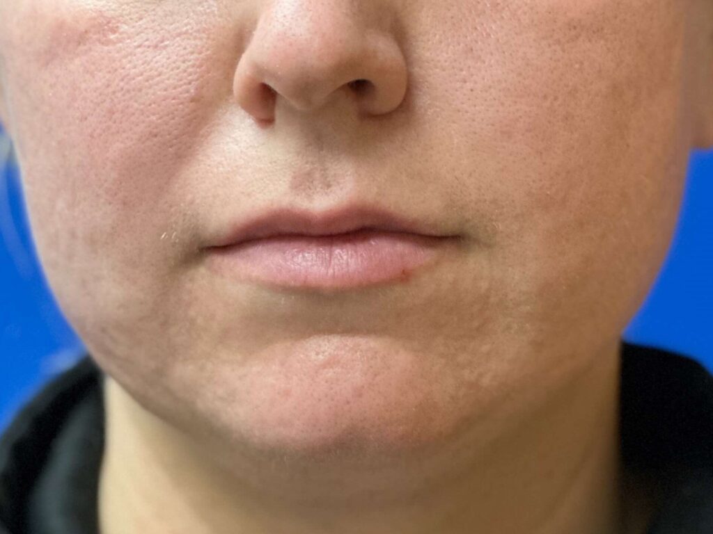 Before Image: Restylane® - front