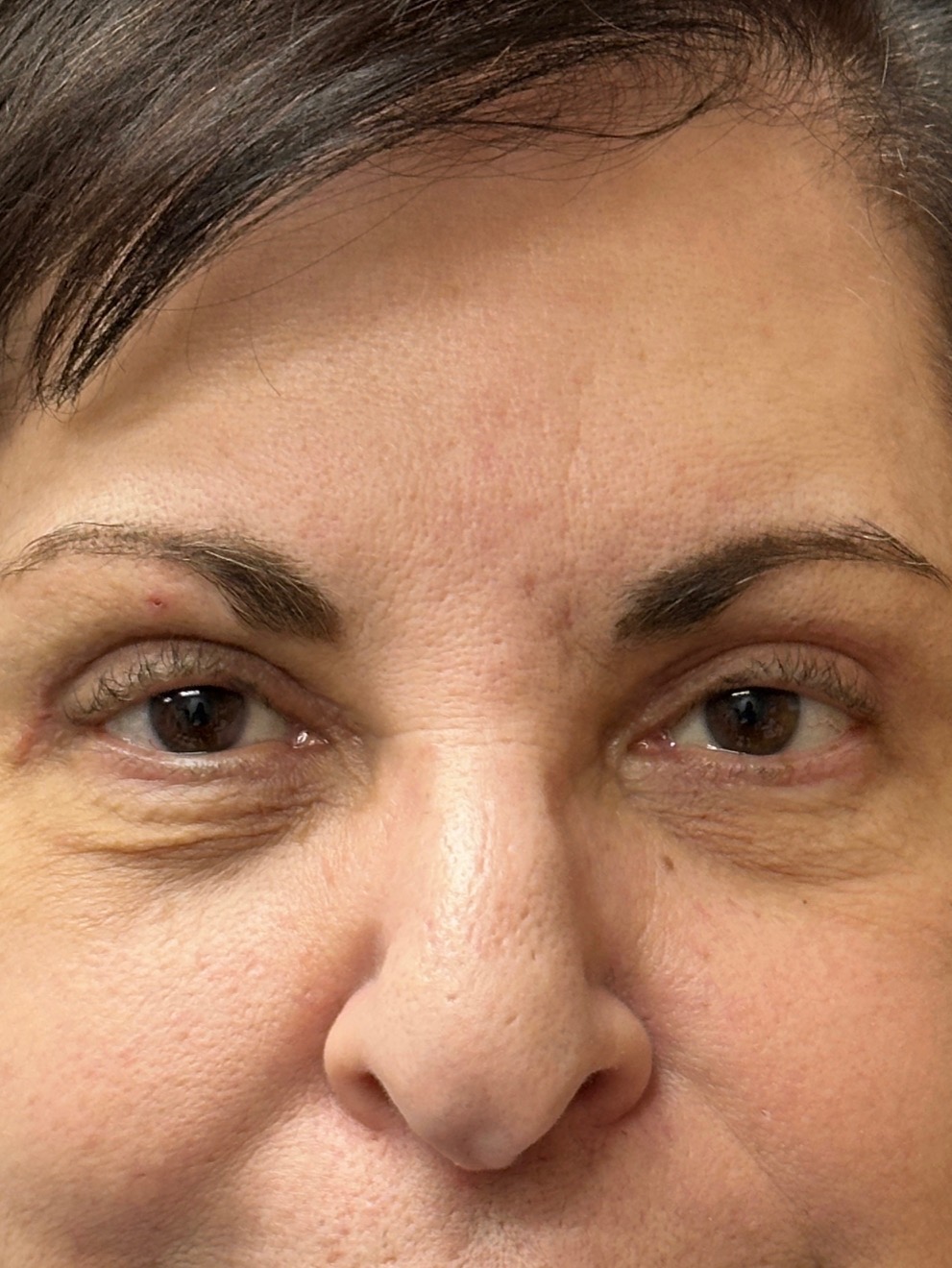 After Image: Blepharoplasty - front