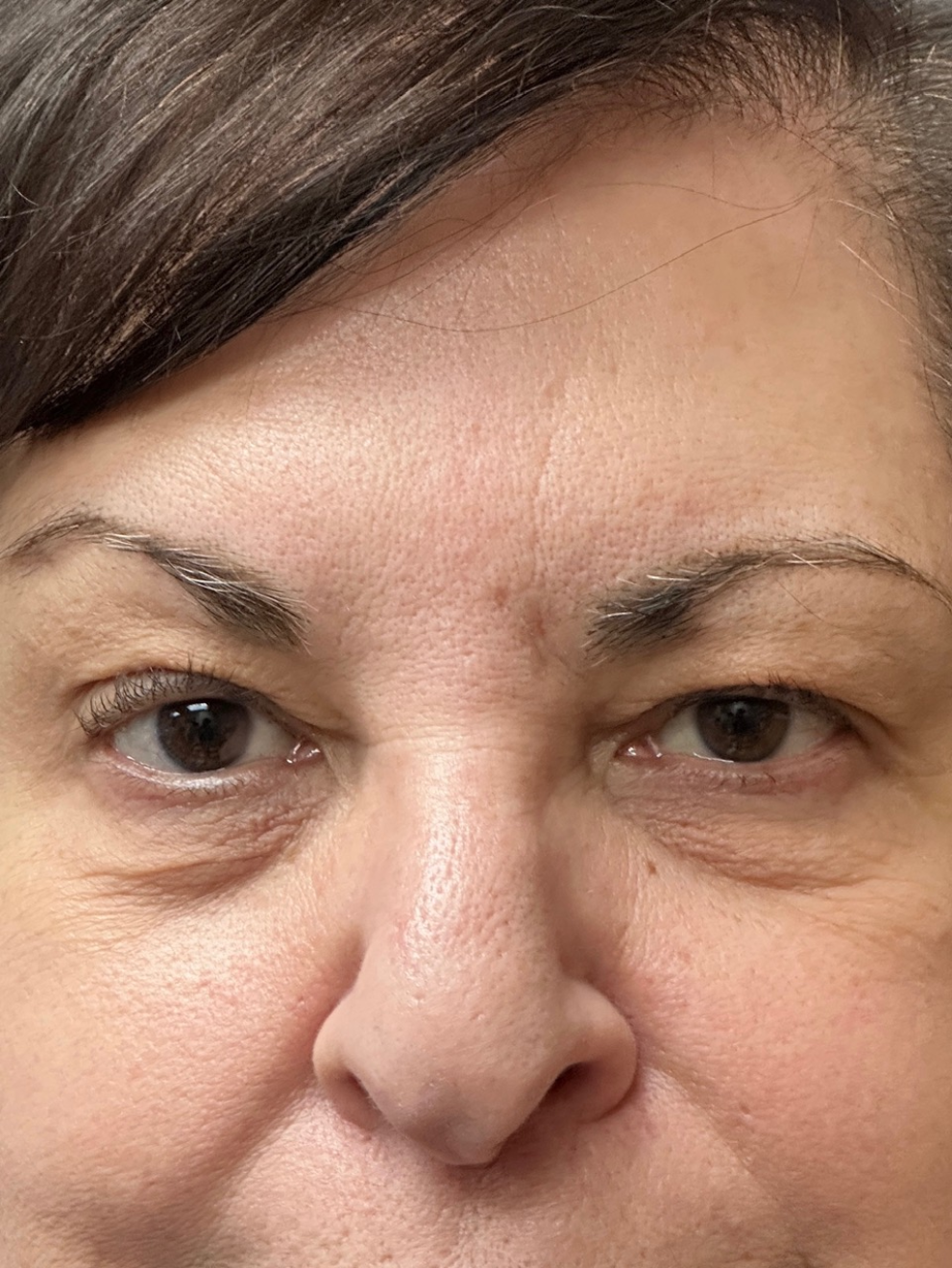 Before Image: Blepharoplasty - front