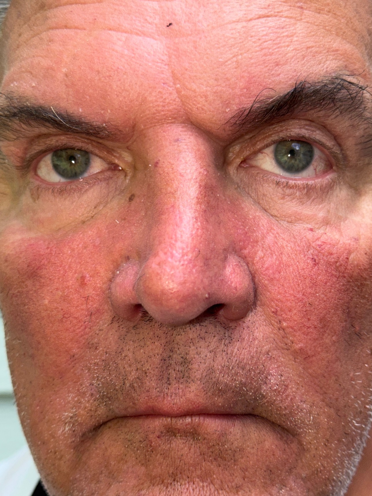 After Image: Blepharoplasty - front