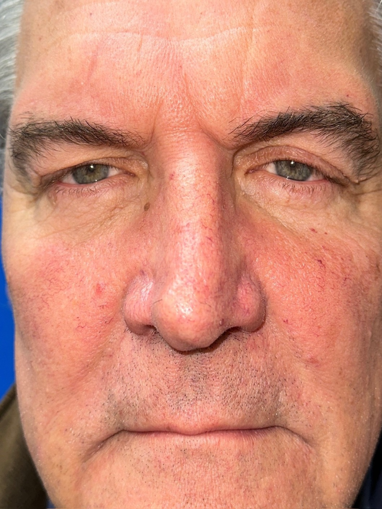 Before Image: Blepharoplasty - front