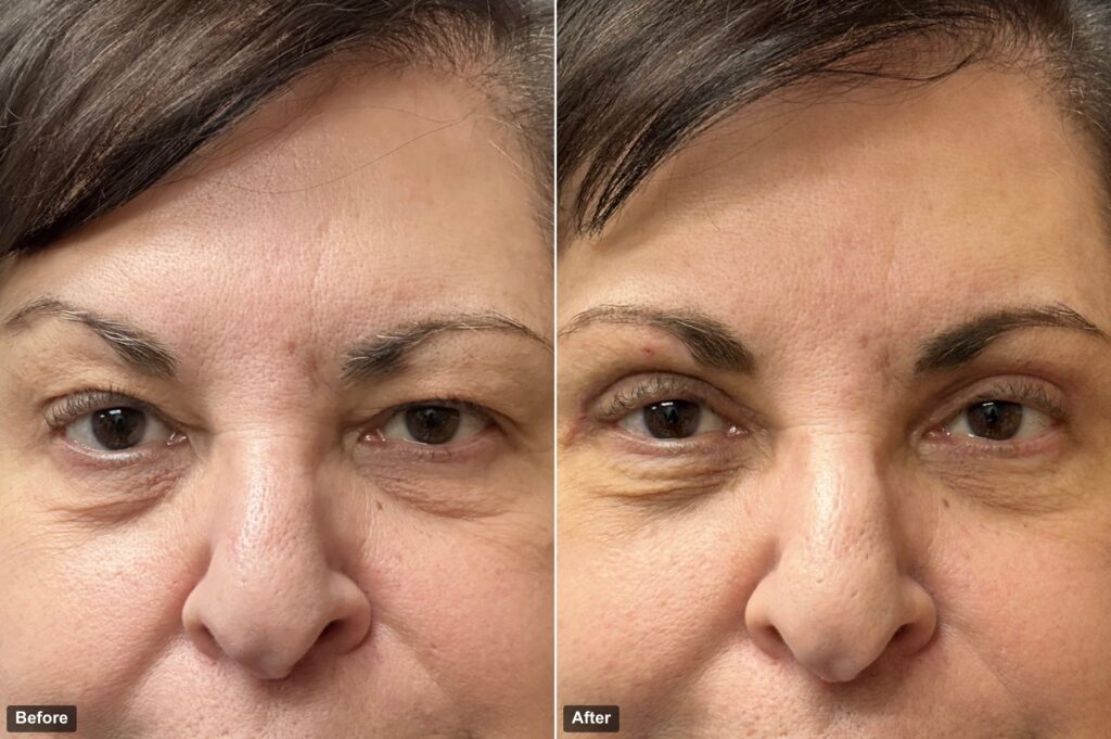 before after Upper Lid Blepharoplasty: Refresh Your Appearance with Dr. Jean Keamy