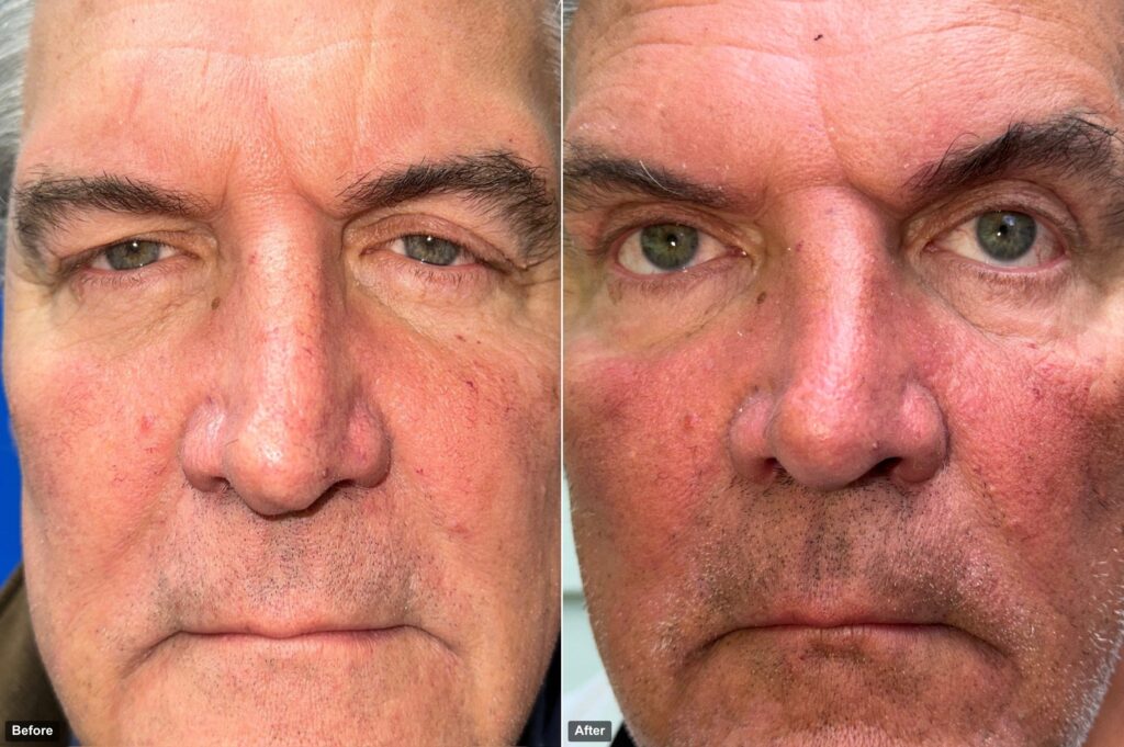 before after 2 Upper Lid Blepharoplasty: Refresh Your Appearance with Dr. Jean Keamy